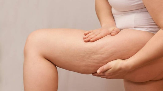 ¿Qué es la Celulitis y qué lo causa?