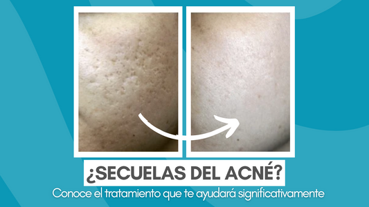 ¿Secuelas del acné? Conoce el tratamiento que te ayudará significativamente