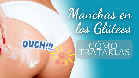 ¿Qué causa las manchas en los glúteos por foliculitis y cómo tratarlas?