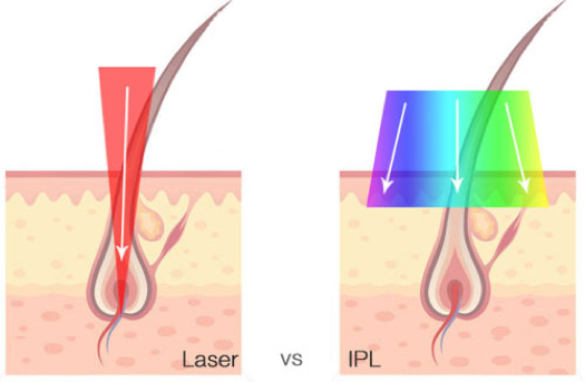 Depilación con láser de diodo vs. luz pulsada: ¿conoces la diferencia?