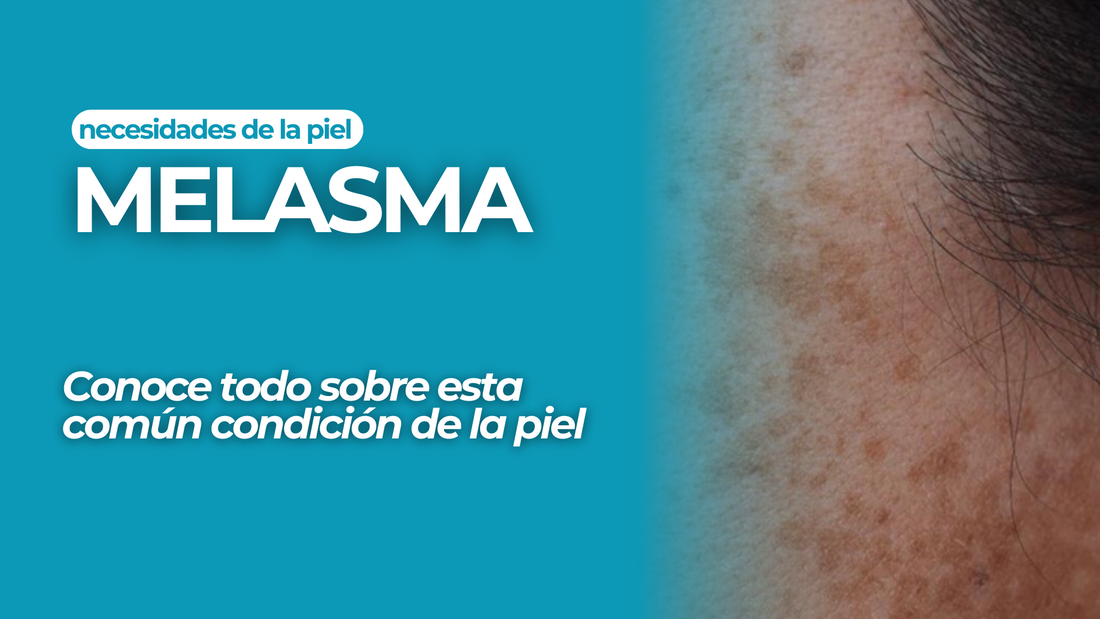 Conoce todo sobre el Melasma