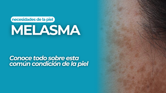 Conoce todo sobre el Melasma